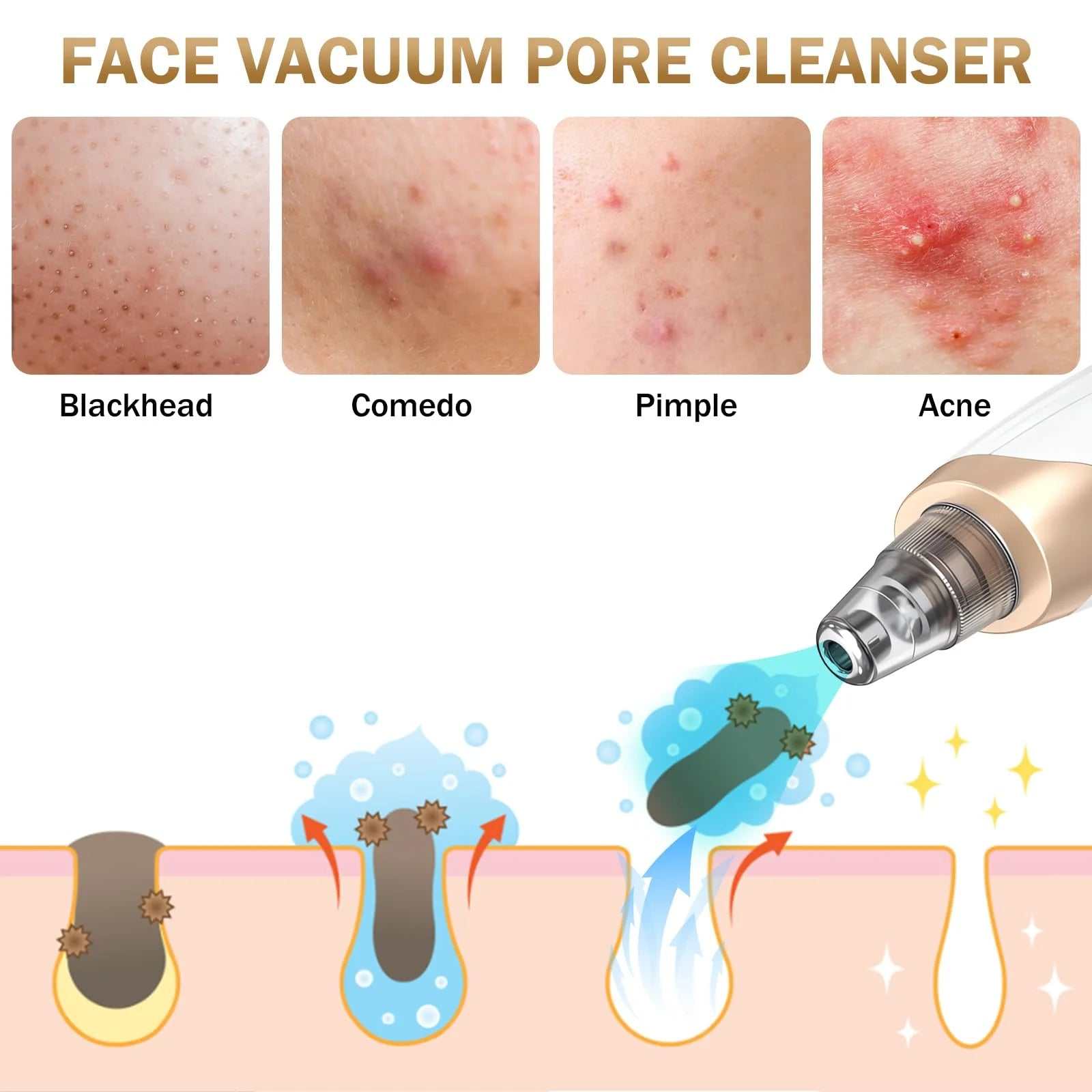 Blackhead Remover Vacuum
